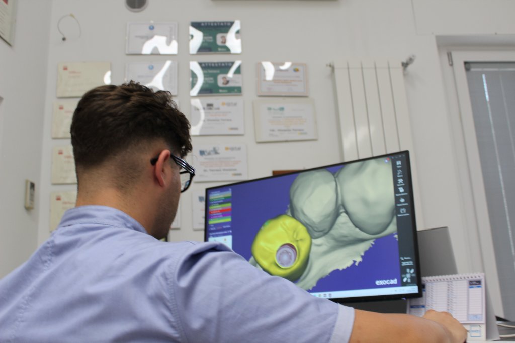 Fase di progettazione digitale CAD con EXOCAD